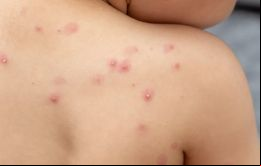 Quienes han tenido mpox en el pasado tienen más probabilidades de tener alguna inmunidad que otras, explicó la OMS