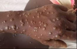 La mpox sigue siendo una grave emergencia de salud pública en África, advirtió el director de CDC África