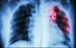 La tuberculosis y la Covid-19 son enfermedades respiratorias con síntomas similares