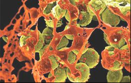 La bacteria, CRE (carbapenem-resistant enterobacteriaceae), fue transmitida a algunos pacientes por instrumentos médicos contaminados durante endoscopías