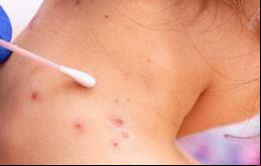 Al tratarse de una enfermedad bien conocida, los centros de salud de muchos países cuentan desde hace tiempo con protocolos