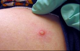 Todos los pacientes eran varones biológicos (99,5% de sexo masculino legal y uno era una persona transgénero legalmente femenina), pero la enfermedad puede afectar a cualquier persona