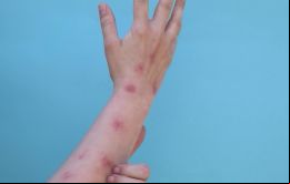 Mpox y Covid 19: Ambos virus siguen circulando y ambos siguen matando, advirtió Tedros 